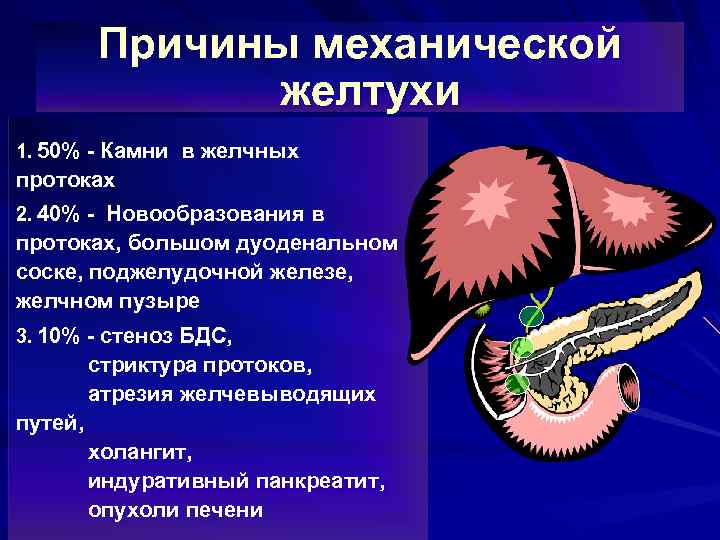 Причины механической желтухи 1. 50% - Камни в желчных протоках 2. 40% - Новообразования