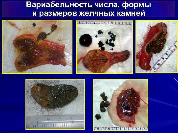 Вариабельность числа, формы и размеров желчных камней 