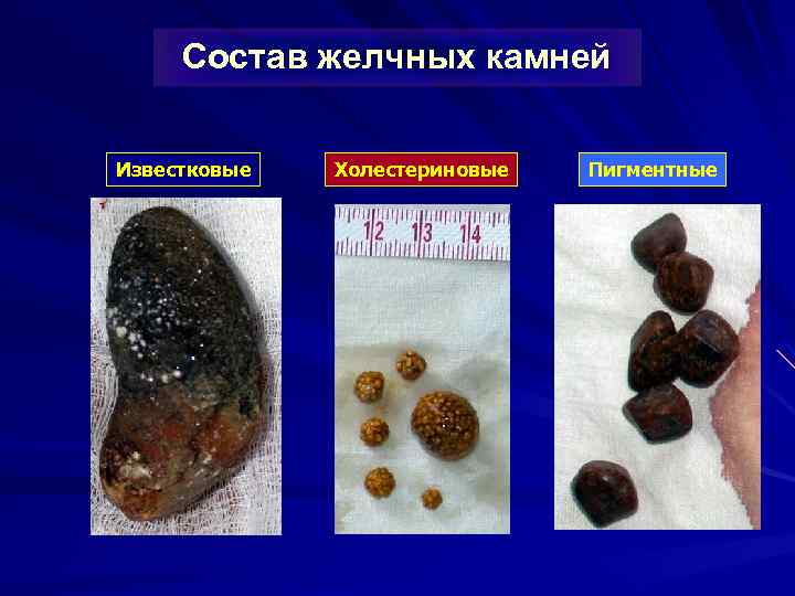Состав желчных камней Известковые Холестериновые Пигментные 