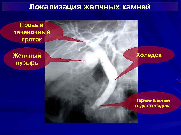 Локализация желчных камней Правый печеночный проток Желчный пузырь Холедох Терминальный отдел холедоха 