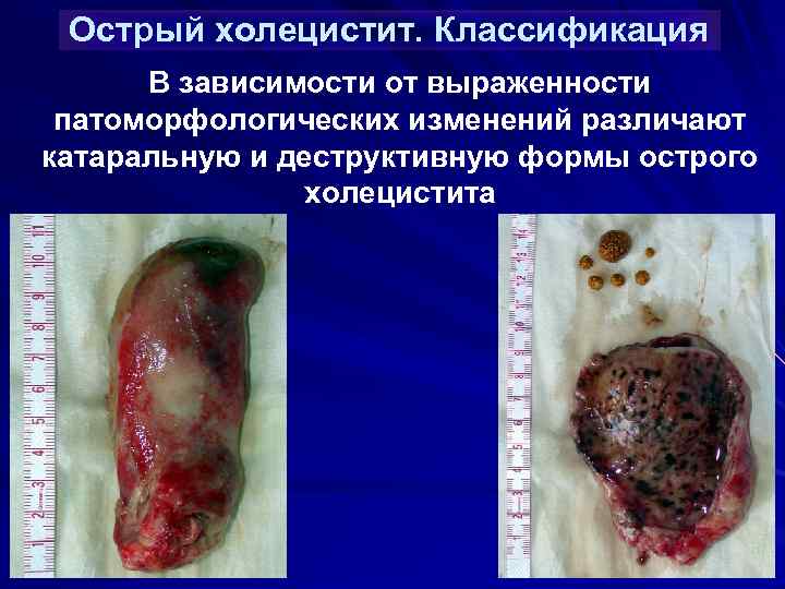 Острый холецистит. Классификация В зависимости от выраженности патоморфологических изменений различают катаральную и деструктивную формы