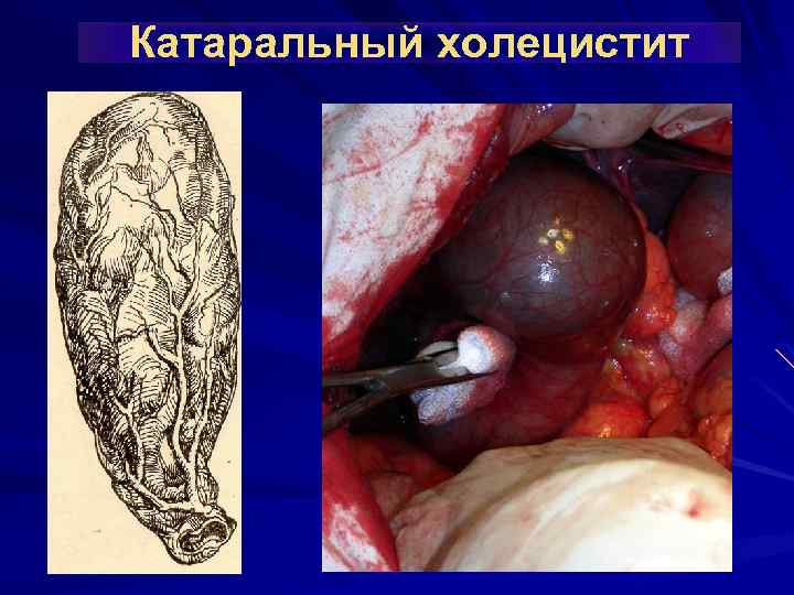 Катаральный холецистит 