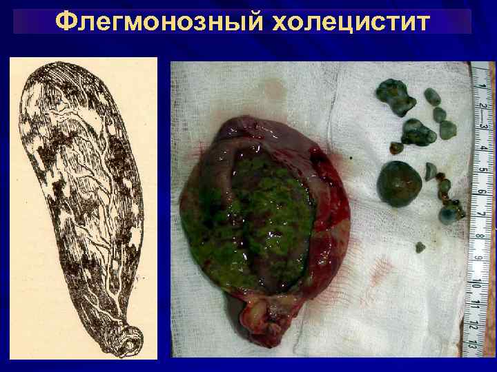 Флегмонозный холецистит 