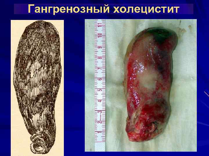 Гангренозный холецистит 