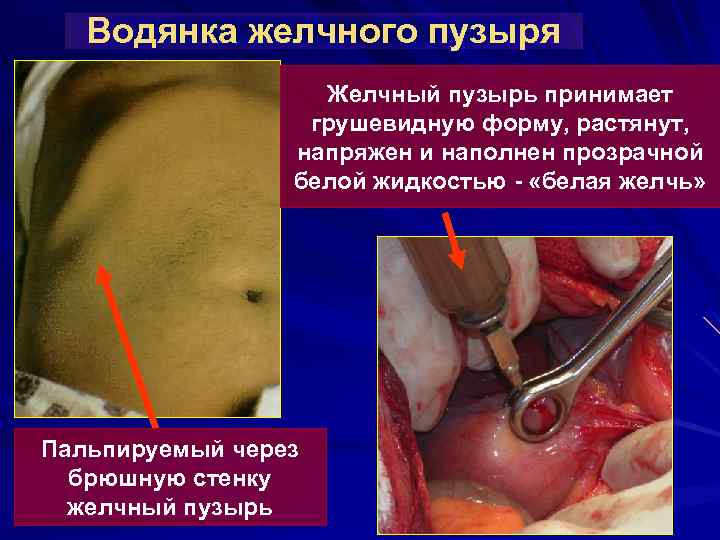 Водянка желчного пузыря Желчный пузырь принимает грушевидную форму, растянут, напряжен и наполнен прозрачной белой