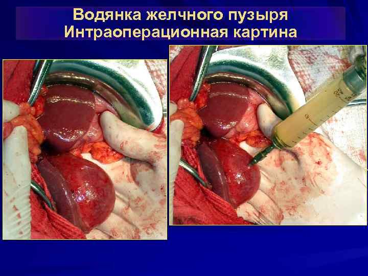 Водянка желчного пузыря Интраоперационная картина 