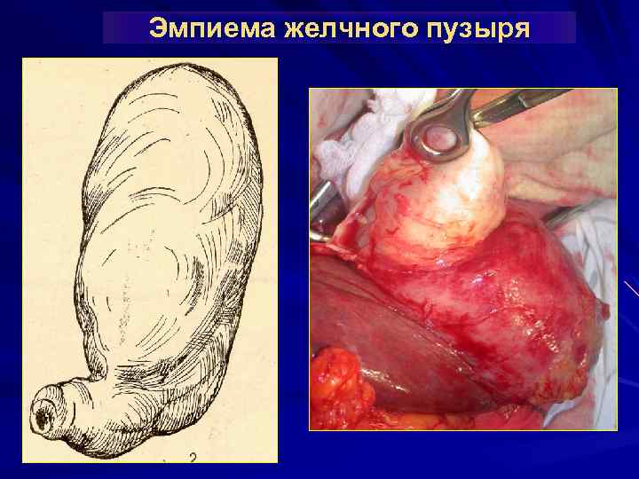 Эмпиема желчного пузыря 