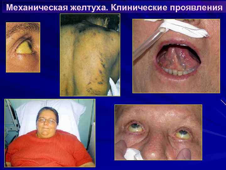 Механическая желтуха. Клинические проявления 