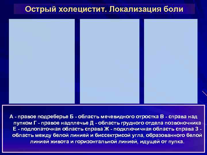 Острый холецистит. Локализация боли А - правое подреберье Б - область мечевидного отростка В