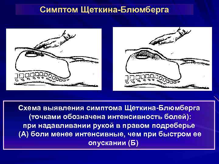 Симптом Щеткина-Блюмберга Схема выявления симптома Щеткина-Блюмберга (точками обозначена интенсивность болей): при надавливании рукой в