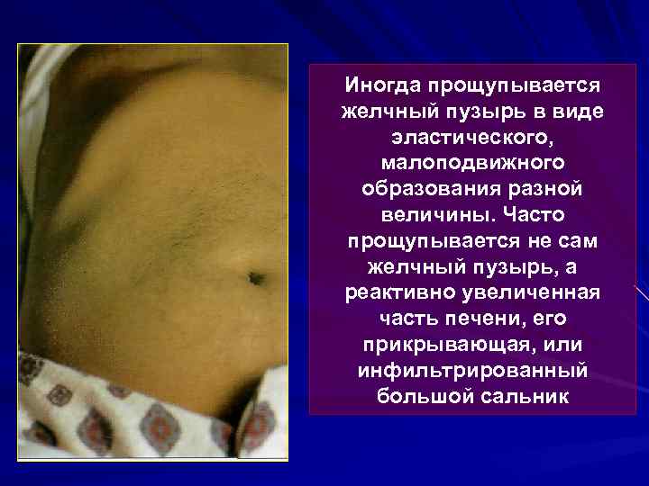 Иногда прощупывается желчный пузырь в виде эластического, малоподвижного образования разной величины. Часто прощупывается не