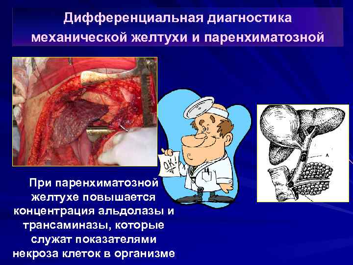 Дифференциальная диагностика механической желтухи и паренхиматозной При паренхиматозной желтухе повышается концентрация альдолазы и трансаминазы,