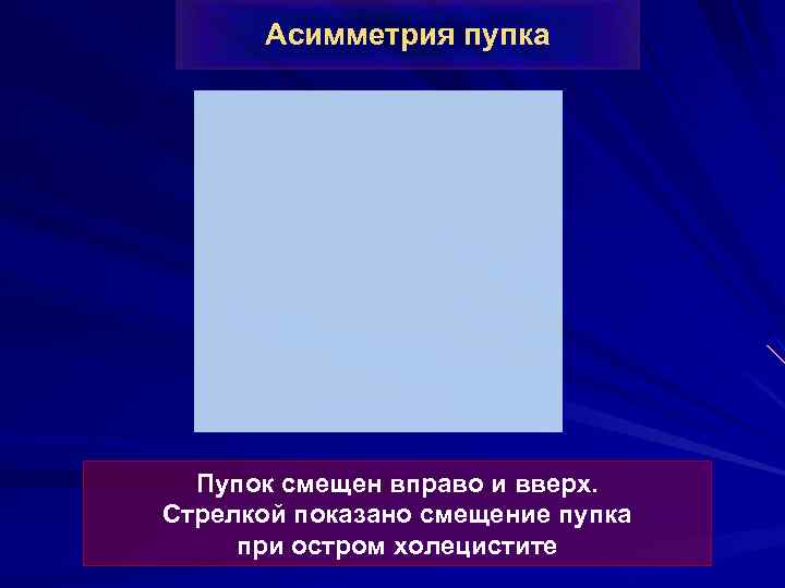 Асимметрия пупка Пупок смещен вправо и вверх. Стрелкой показано смещение пупка при остром холецистите