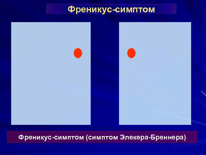 Френикус-симптом (симптом Элекера-Бреннера) 