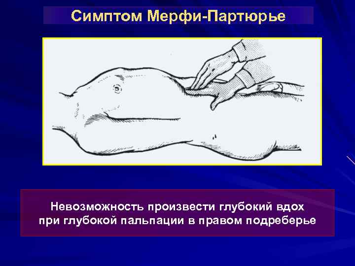 Симптом Мерфи-Партюрье Невозможность произвести глубокий вдох при глубокой пальпации в правом подреберье 