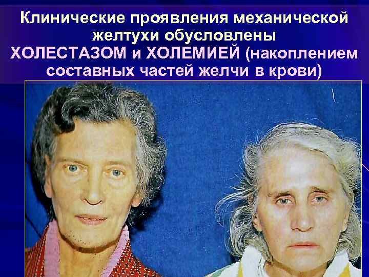 Клинические проявления механической желтухи обусловлены ХОЛЕСТАЗОМ и ХОЛЕМИЕЙ (накоплением составных частей желчи в крови)
