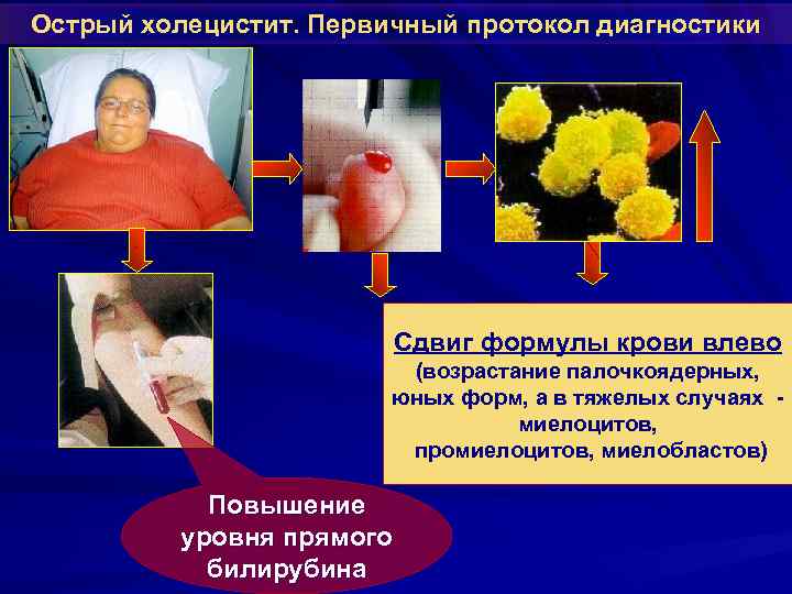 Острый холецистит. Первичный протокол диагностики Сдвиг формулы крови влево (возрастание палочкоядерных, юных форм, а