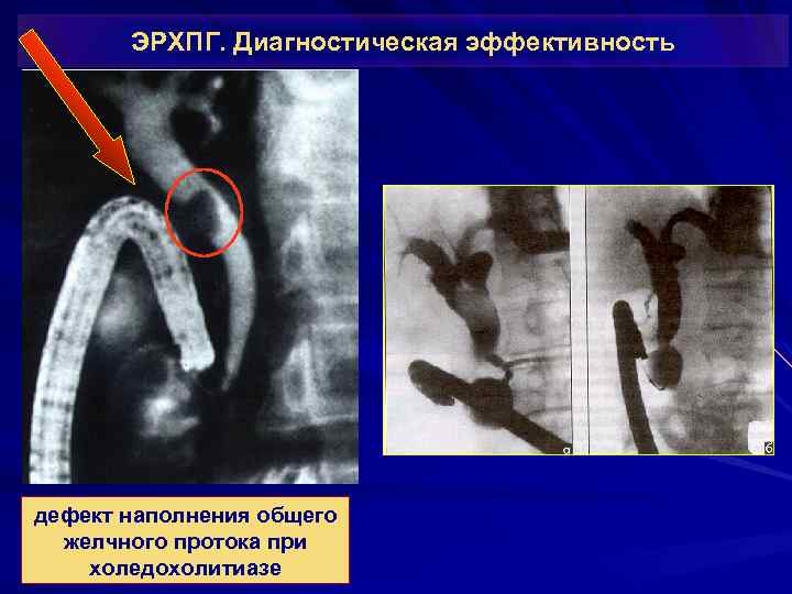 ЭРХПГ. Диагностическая эффективность дефект наполнения общего желчного протока при холедохолитиазе 