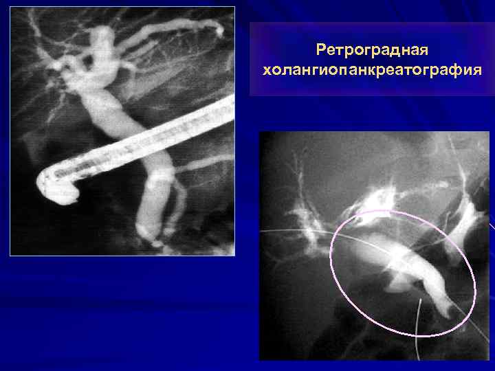 Ретроградная холангиопанкреатография 