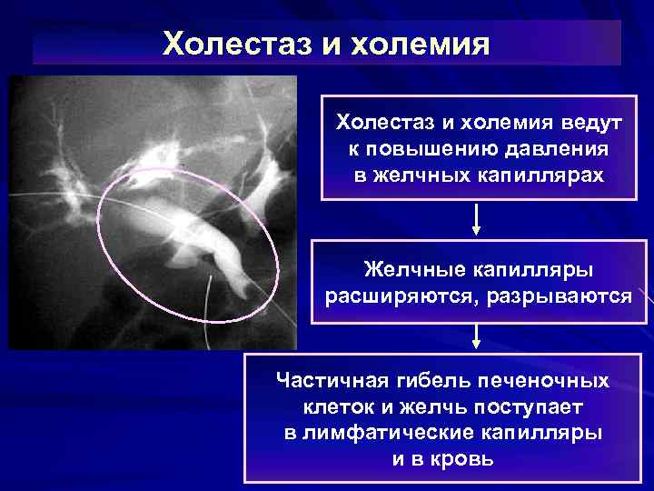 Холестаз и холемия ведут к повышению давления в желчных капиллярах Желчные капилляры расширяются, разрываются