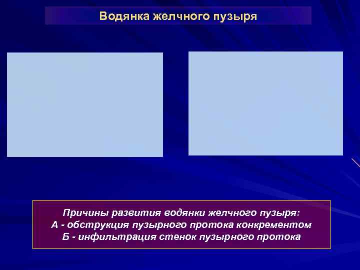 Водянка желчного пузыря Причины развития водянки желчного пузыря: А - обструкция пузырного протока конкрементом