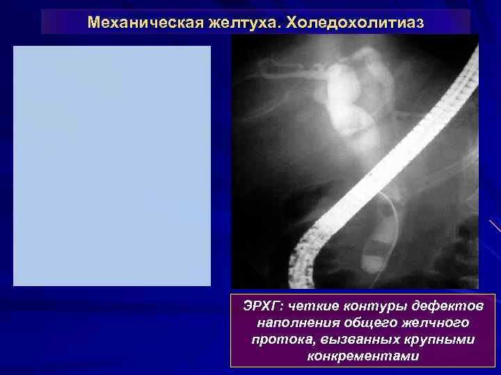 Механическая желтуха. Холедохолитиаз ЭРХГ: четкие контуры дефектов наполнения общего желчного протока, вызванных крупными конкрементами