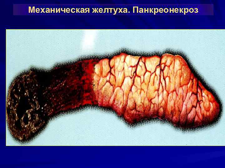 Механическая желтуха. Панкреонекроз 
