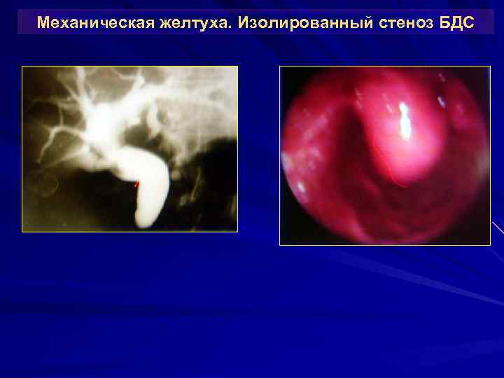 Механическая желтуха. Изолированный стеноз БДС 