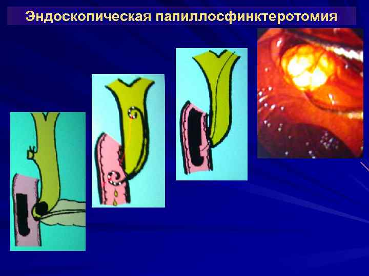 Эндоскопическая папиллосфинктеротомия 