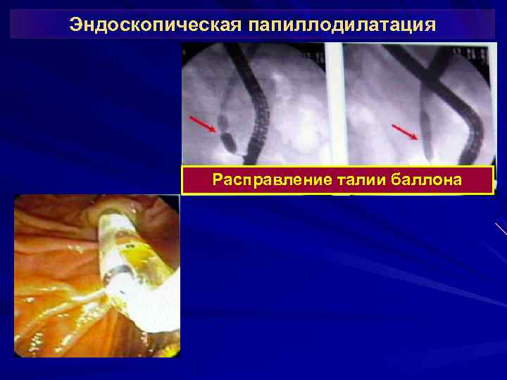 Эндоскопическая папиллодилатация Расправление талии баллона 