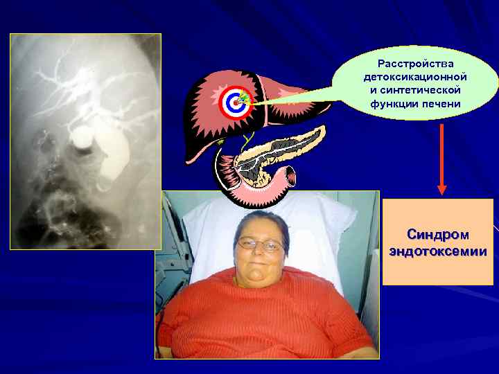 Расстройства детоксикационной и синтетической функции печени Синдром эндотоксемии 