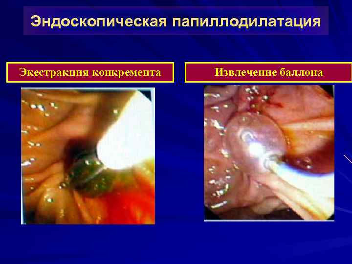 Эндоскопическая папиллодилатация Экестракция конкремента Извлечение баллона 