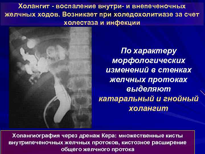 Холангит - воспаление внутри- и внепеченочных желчных ходов. Возникает при холедохолитиазе за счет холестаза