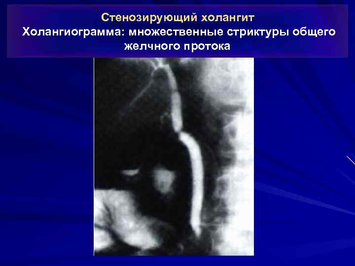 Стенозирующий холангит Холангиограмма: множественные стриктуры общего желчного протока 