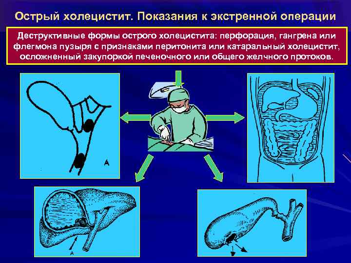 Острый холецистит. Показания к экстренной операции Деструктивные формы острого холецистита: перфорация, гангрена или флегмона