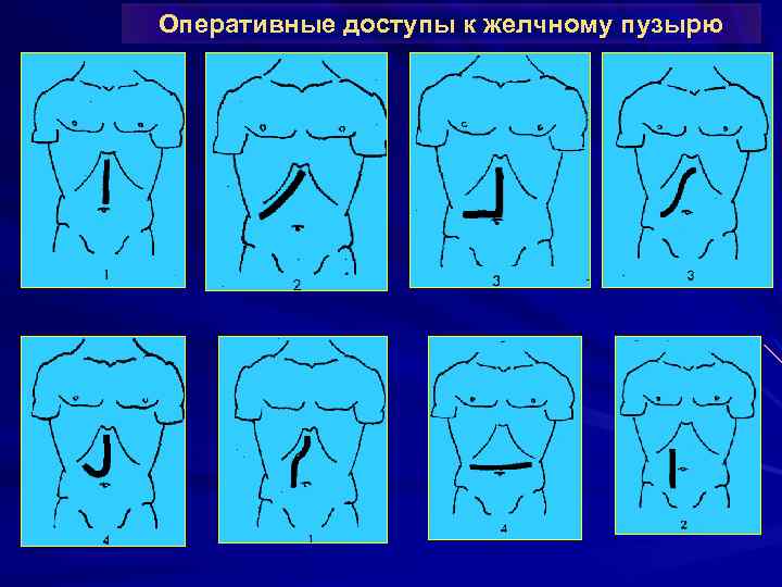 Оперативные доступы к желчному пузырю 