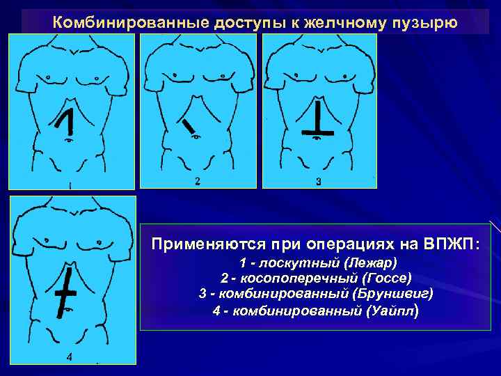 Комбинированные доступы к желчному пузырю Применяются при операциях на ВПЖП: 1 - лоскутный (Лежар)