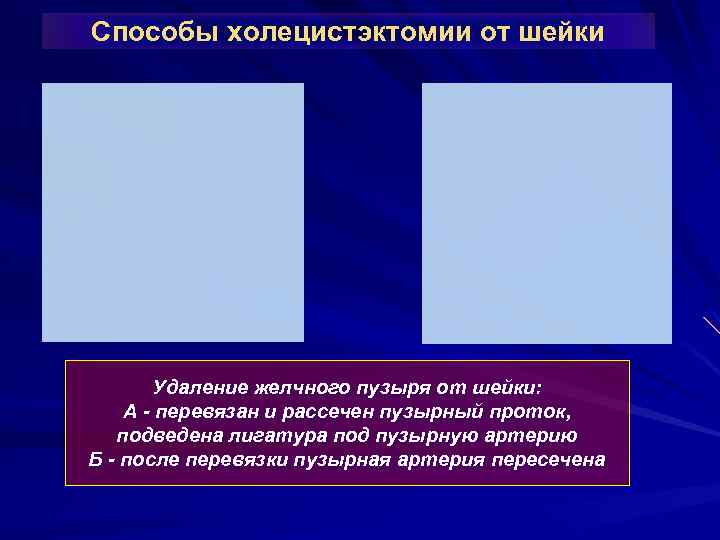 Способы холецистэктомии от шейки Удаление желчного пузыря от шейки: А - перевязан и рассечен