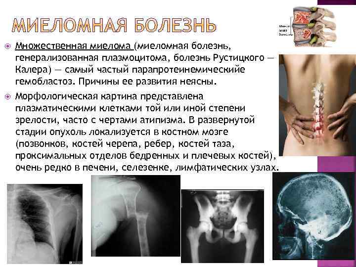  Множественная миелома (миеломная болезнь, генерализованная плазмоцитома, болезнь Рустицкого — Калера) — самый частый