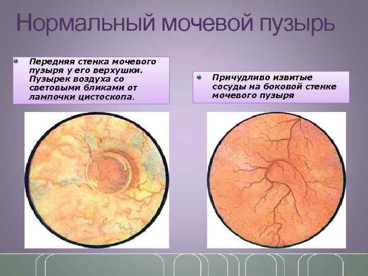 Нормальный мочевой пузырь Передняя стенка мочевого пузыря у его верхушки. Пузырек воздуха со световыми