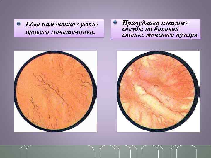 Едва намеченное устье правого мочеточника. Причудливо извитые сосуды на боковой стенке мочевого пузыря .