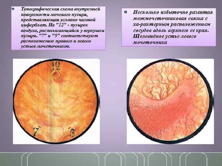 Топографическая схема внутренней поверхности мочевого пузыря, представляющая условно часовой циферблат. На "12" - пузырек