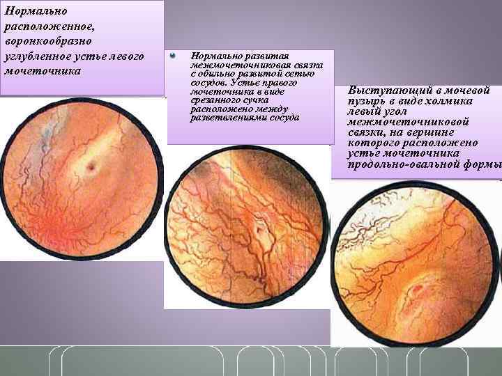 Нормально расположенное, воронкообразно углубленное устье левого мочеточника Нормально развитая межмочеточниковая связка с обильно развитой