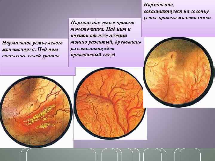 Нормальное устье левого мочеточника. Под ним скопление солей уратов Нормальное устье правого мочеточника. Над