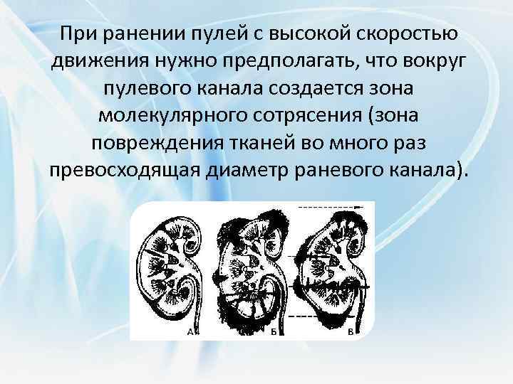 При ранении пулей с высокой скоростью движения нужно предполагать, что вокруг пулевого канала создается