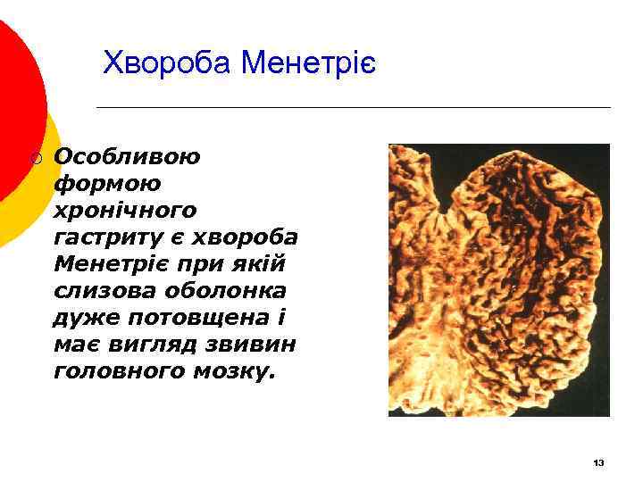Хвороба Менетріє ¡ Особливою формою хронічного гастриту є хвороба Менетріє при якій слизова оболонка