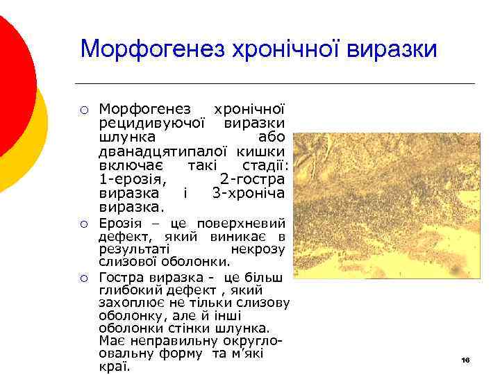 Морфогенез хронічної виразки ¡ ¡ ¡ Морфогенез хронічної рецидивуючої виразки шлунка або дванадцятипалої кишки