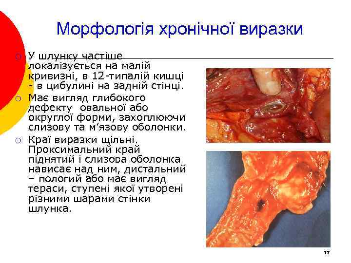 Морфологія хронічної виразки ¡ ¡ ¡ У шлунку частіше локалізується на малій кривизні, в