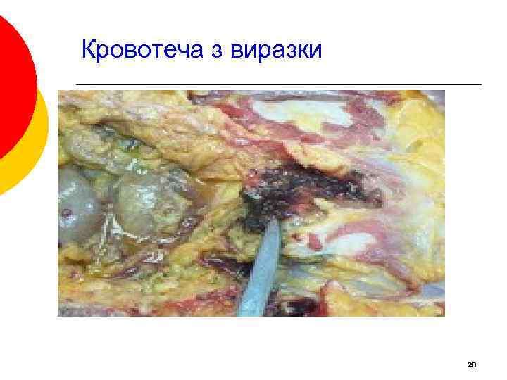Кровотеча з виразки 20 