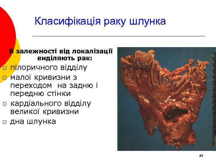Класифікація раку шлунка В залежності від локалізації виділяють рак: ¡ ¡ пілоричного відділу малої